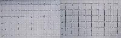 Acute pulmonary embolism combined with acute myocardial infarction as the first manifestation of acute leukemia: a case report